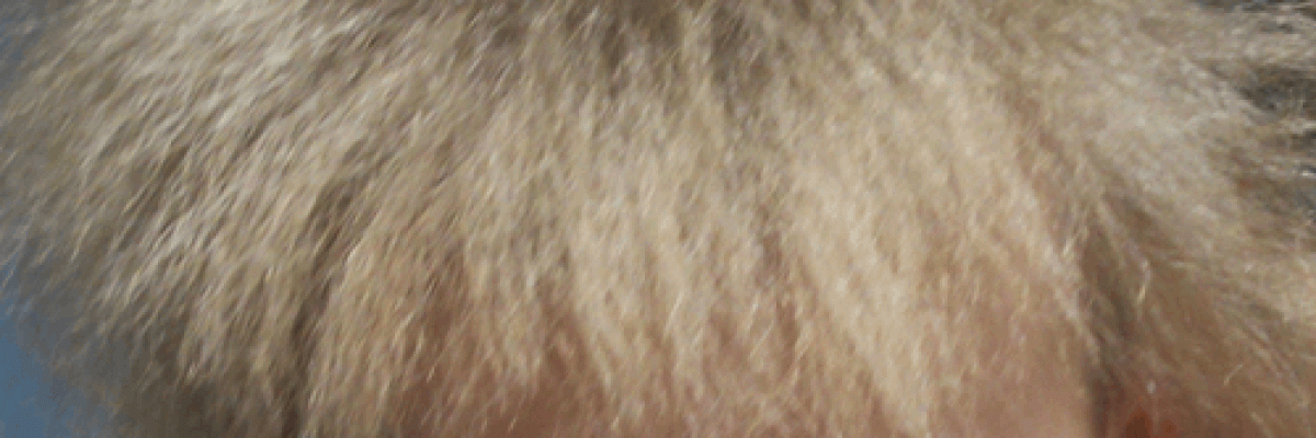 Scalp_hair-uncombable_hair_syndrome